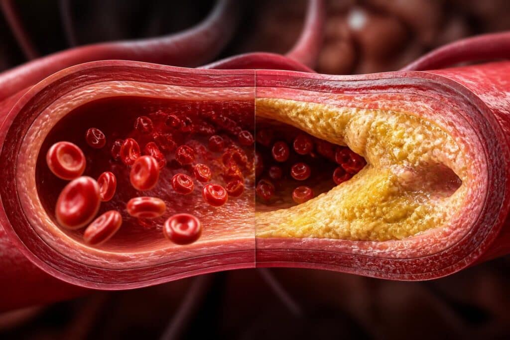 découvrez comment le cholestérol ldl influence l'obstruction des artères et son impact sur la santé cardiovasculaire.