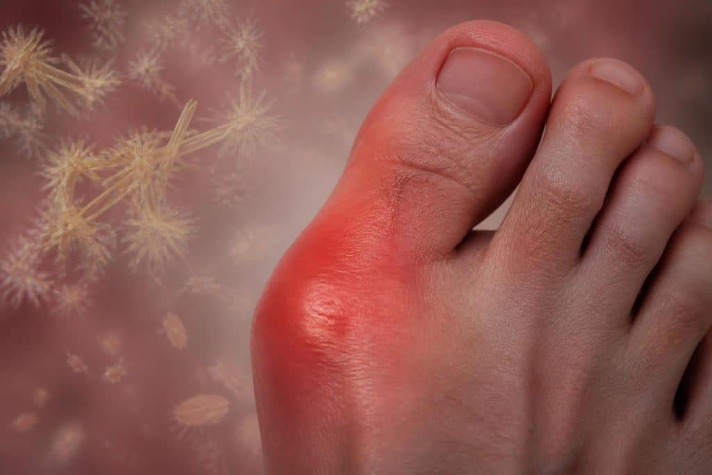 découvrez comment l'acide urique impacte la survenue des crises de goutte et les implications pour la santé afin de mieux comprendre et gérer cette maladie inflammatoire.